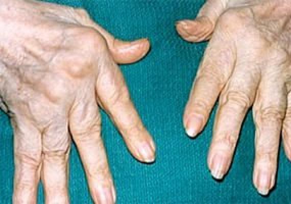 Heikentävä kipu sormien nivelissä: syyt ja hoito